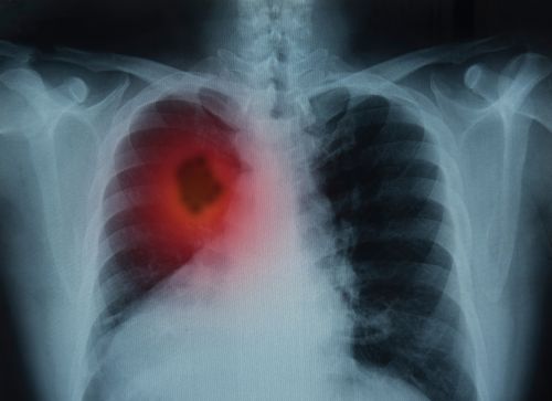 Xray of chest with red mass showing on lefthand side